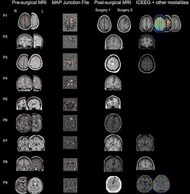 Application of MRI Post-processing in Presurgical Evaluation of Non-lesional Cingulate Epilepsy